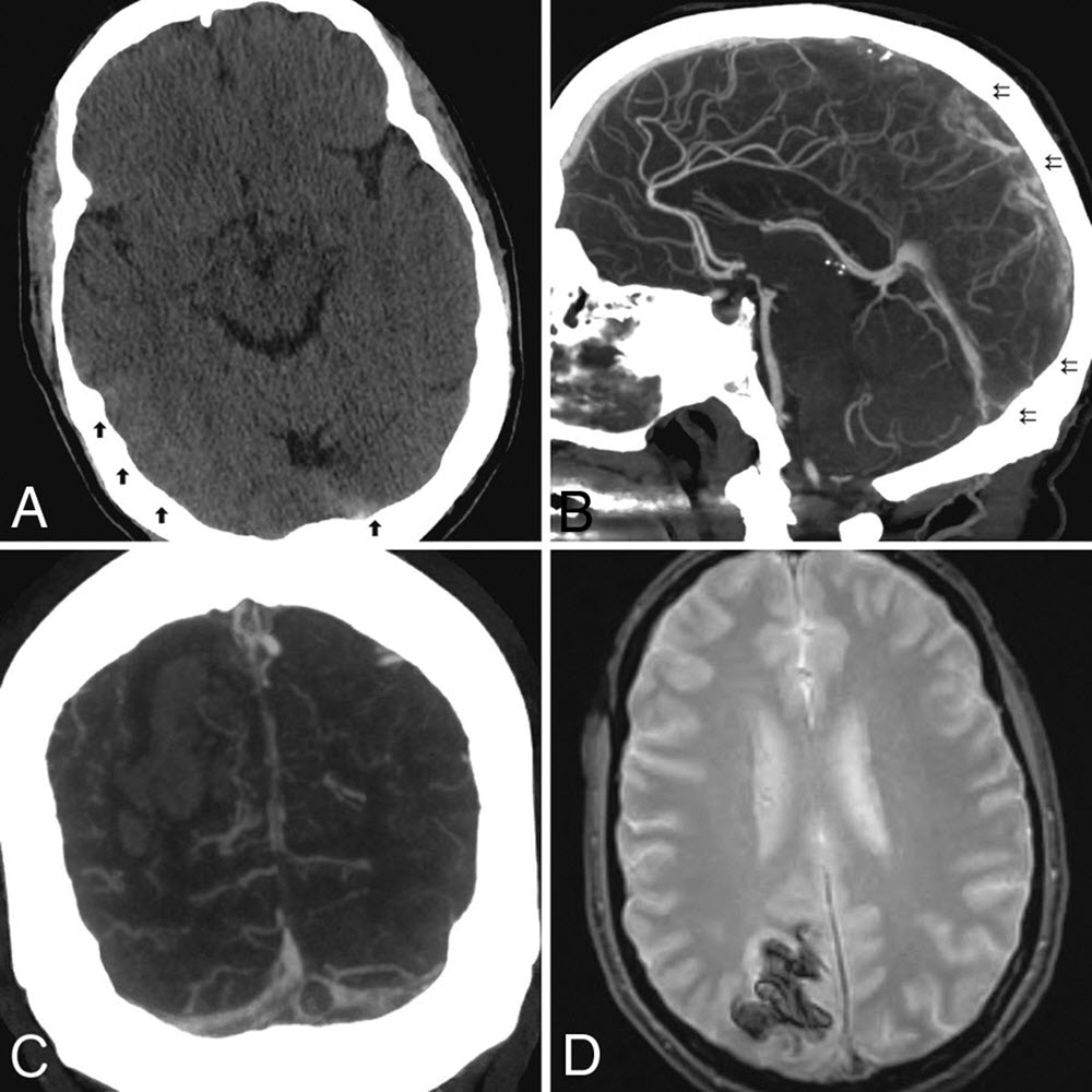 CVT brain scan showing clot occlusion